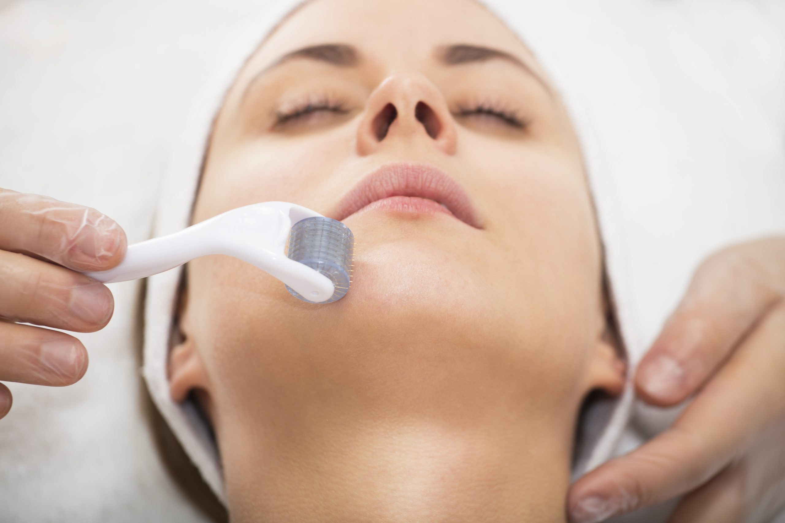 Microneedling